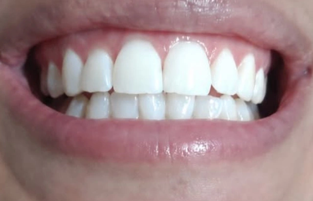 Clareamento dental: depois
