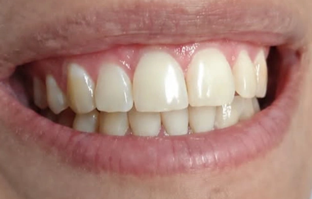 Clareamento dental: antes